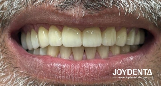 Zirconia dentures that imitate natural teeth