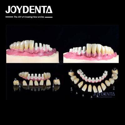 Multiple Endosseous Dental Implants Internal Connection For Full Arch Restoration