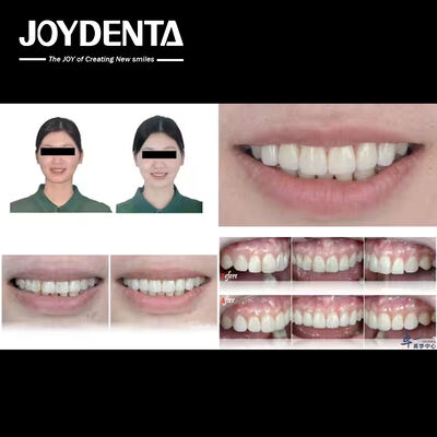 Joydentalab's popular products: Simulated aesthetic veneers