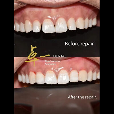Say Hello To A Flawless Smile With Cosmetic Dental Veneers No Discoloration No Preparation