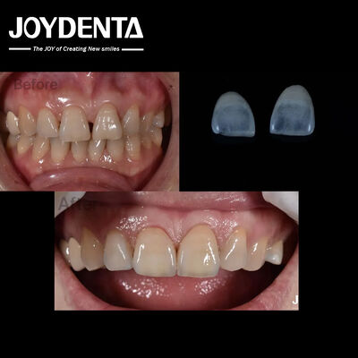 0.5mm Thickness Ceramic Dental Veneers Natural Looking For Anterior Tooth Indication