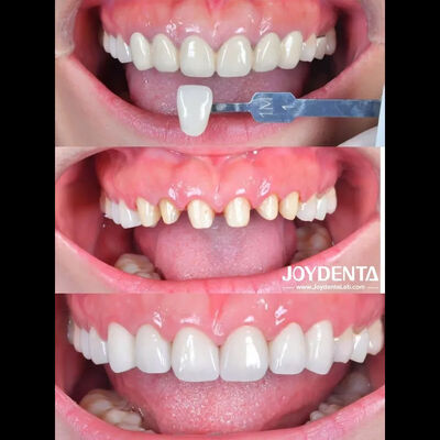 Zirconia Dental Crown Case Study | Global Lab Outsourcing - Joydentalab