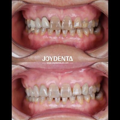 Lightweight Dental Zirconia For Optimal Patient Experience Natural Color