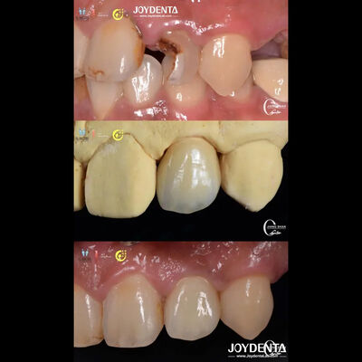 Lifelike Tooth Appearance Zirconia Bridges Dental Restoration Wear Resistant