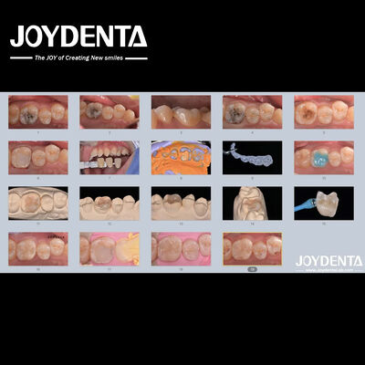 Adults Children Porcelain Ceramic Dental Inlay Restorative for Damaged Teeth