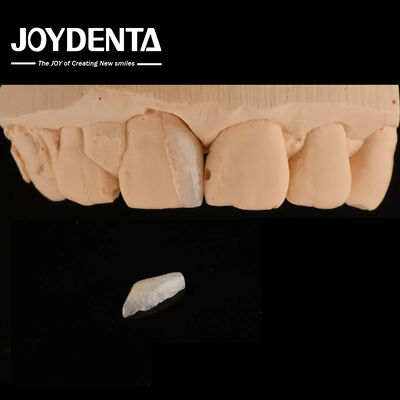 Thin Shell Micro Veneer Cosmetic Dental Treatment Micro Thin Teeth Veneers