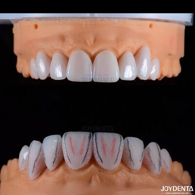 Custom Made Dental Emax Ceramic Veneers With Stain Resistance High Gloss