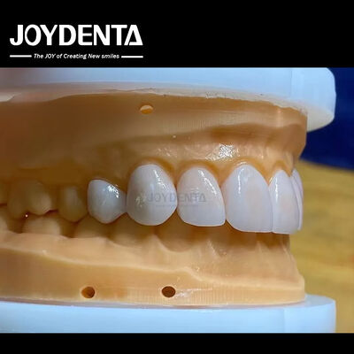 High Permeability Natural Looking Veneers Porcelain Veneers Emax Customized