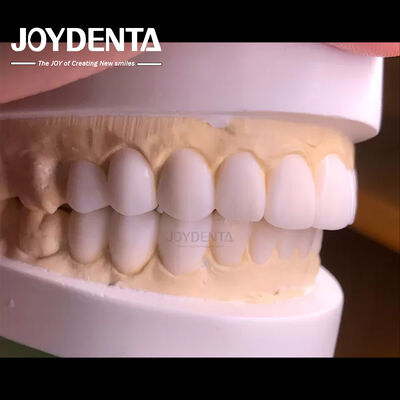 Customized Digital Diagnostic Wax Ups for Natural Tooth Anatomy Replication